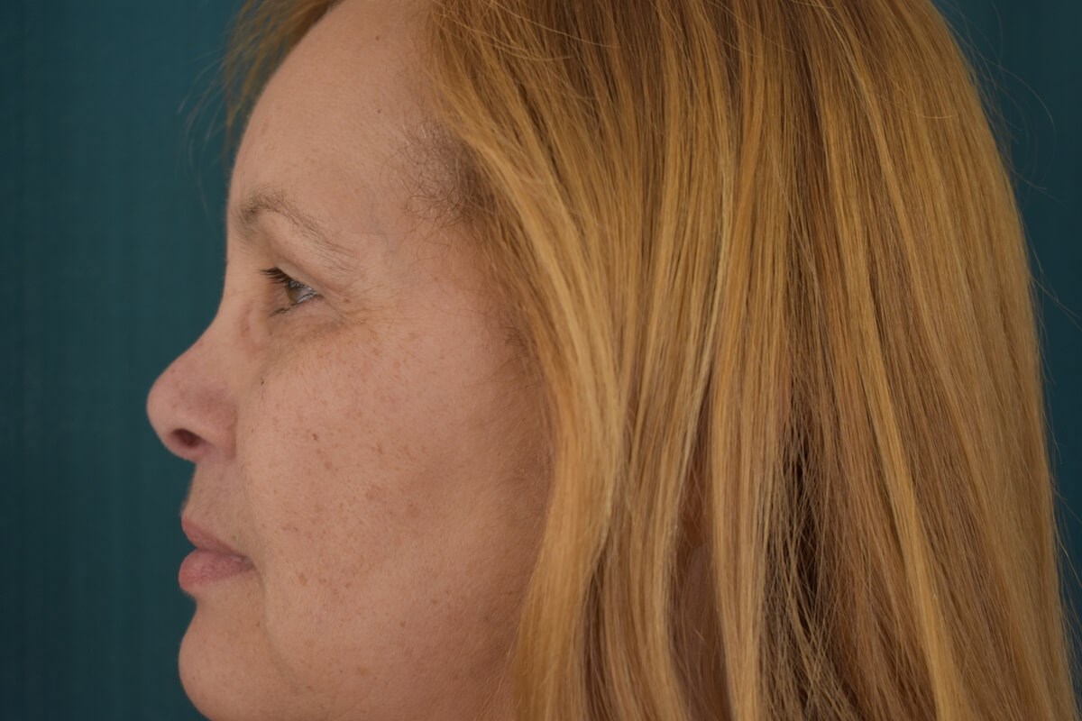 Bilateral Upper Blepharoplasty After