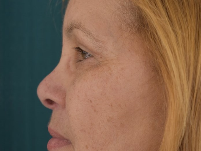 Bilateral Upper Blepharoplasty After