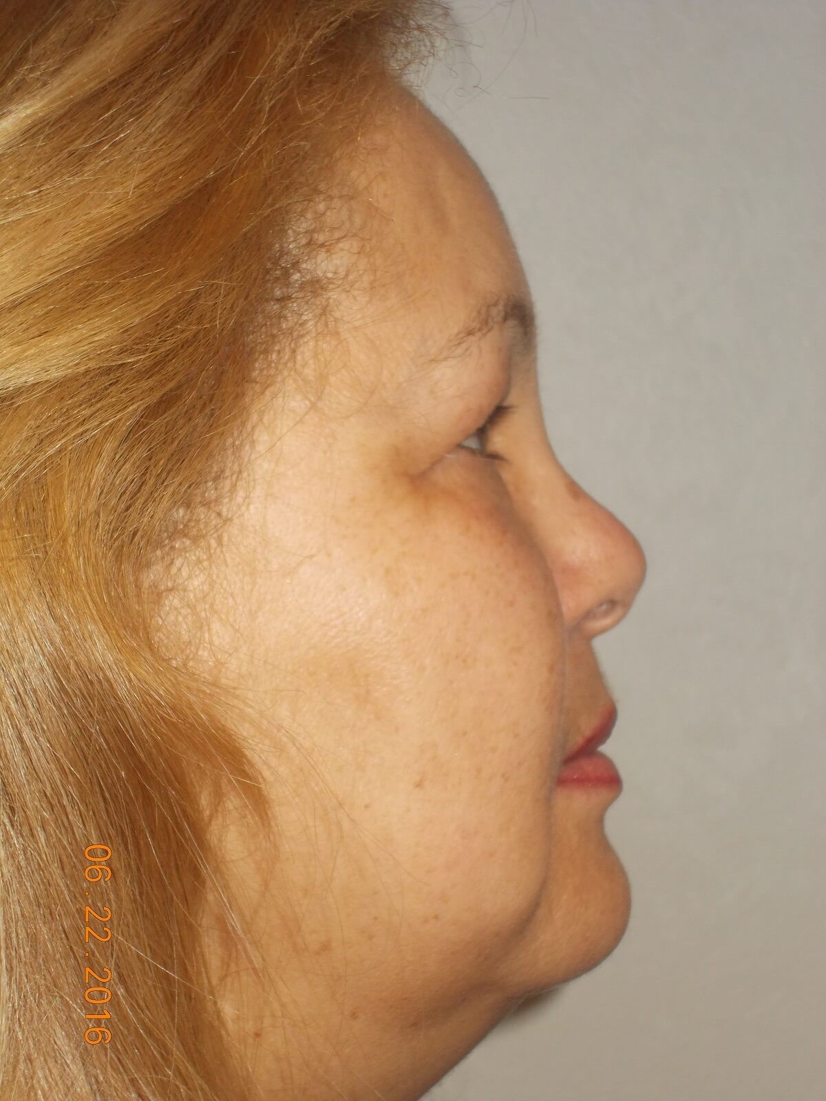 Bilateral Upper Blepharoplasty Before