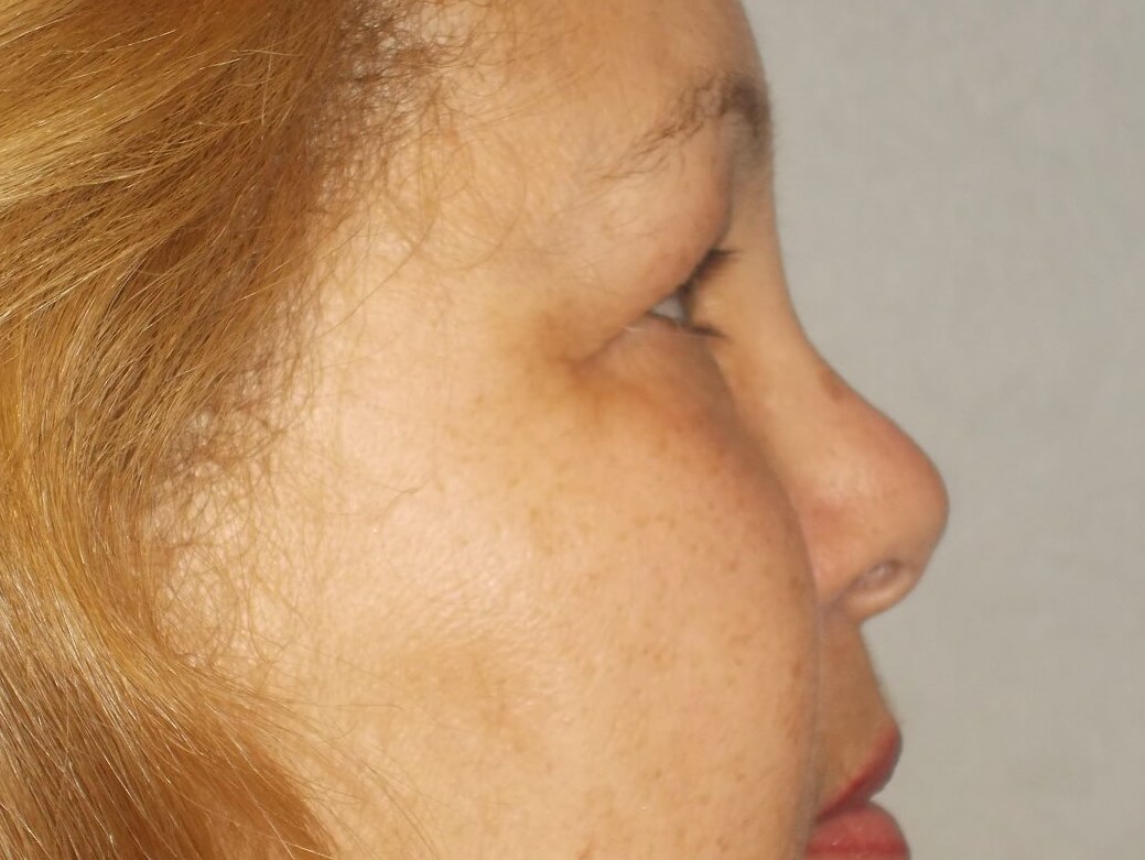 Bilateral Upper Blepharoplasty Before