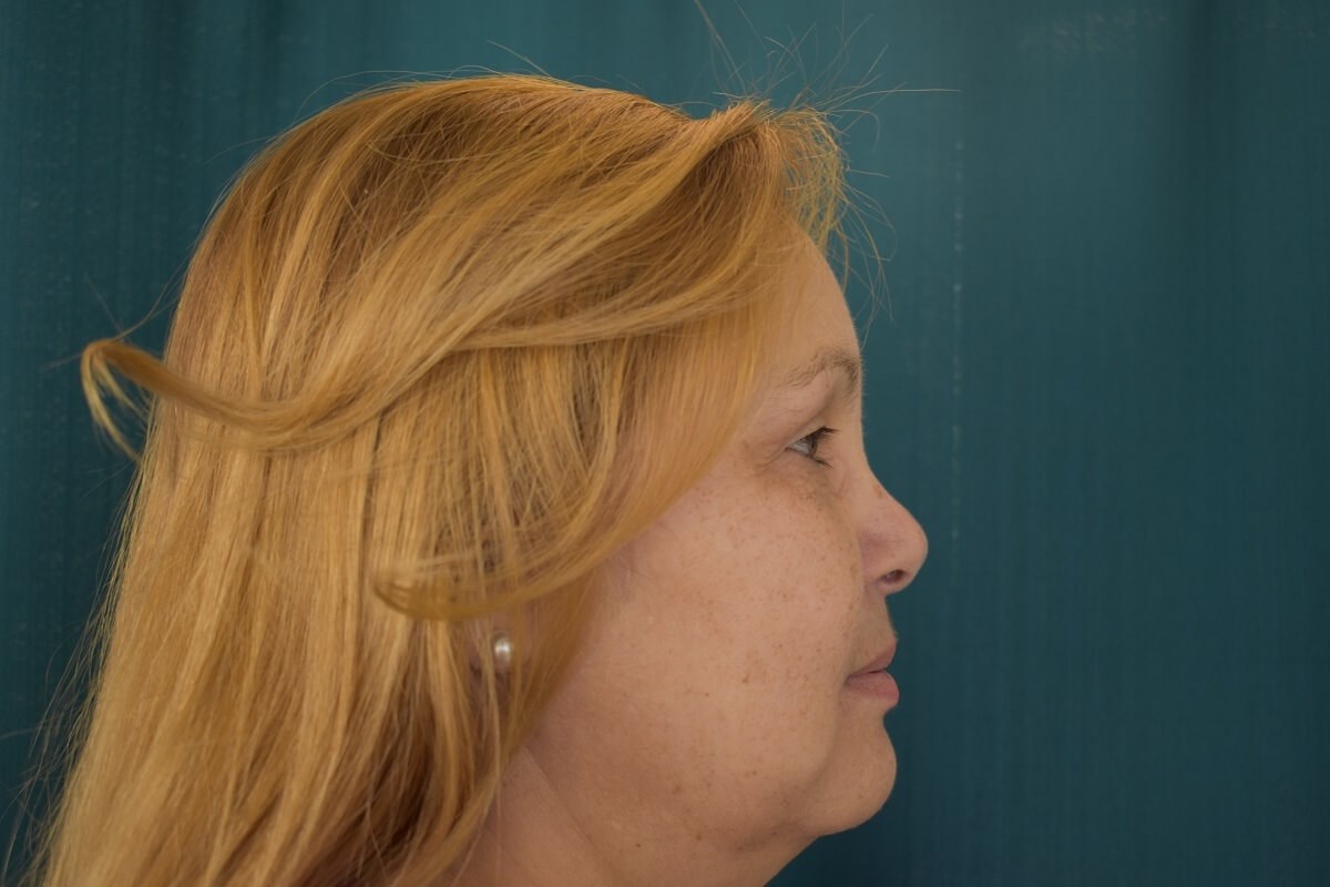 Bilateral Upper Blepharoplasty After