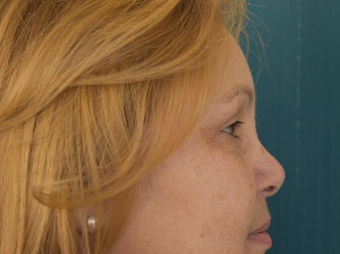 Bilateral Upper Blepharoplasty After