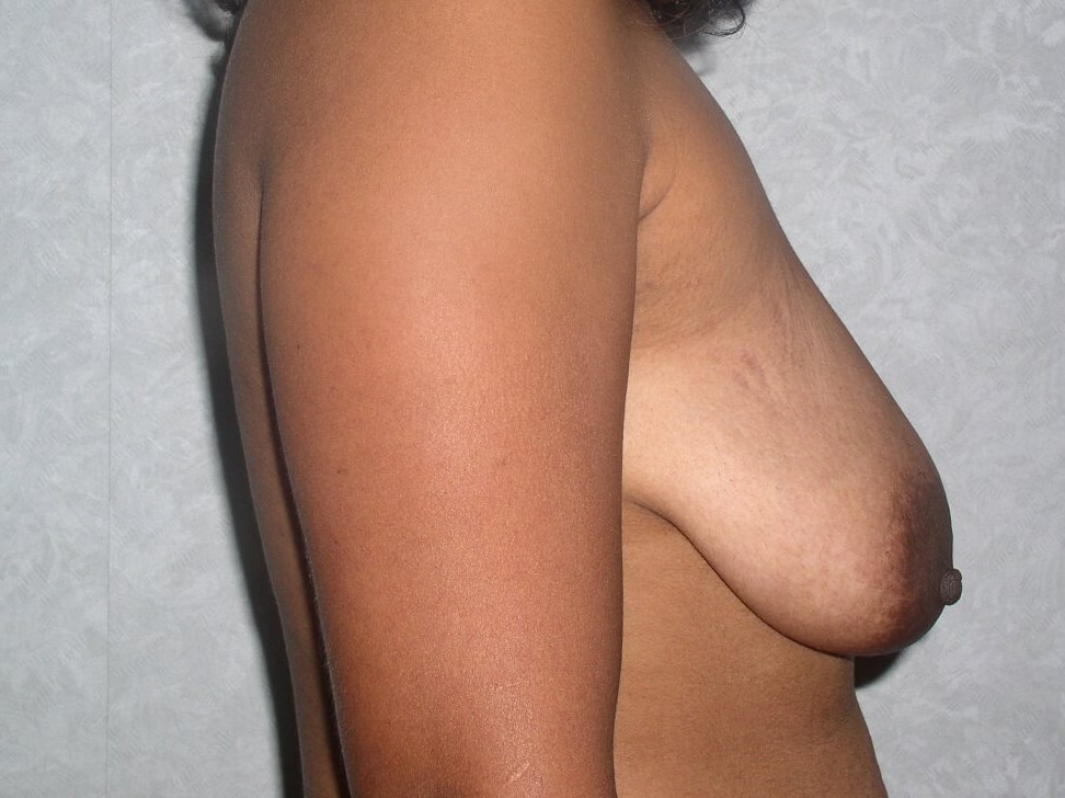Side View Before