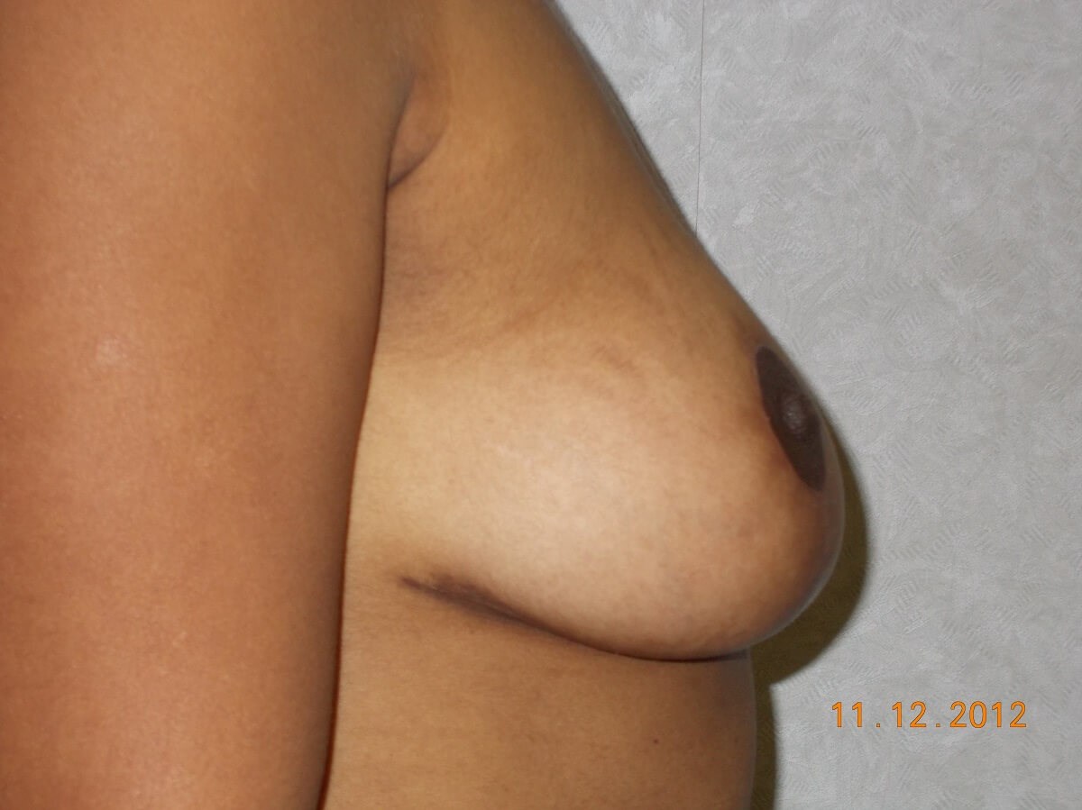 Side View After