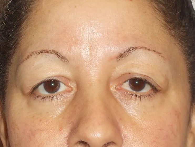 Upper  Blepharoplasty Before