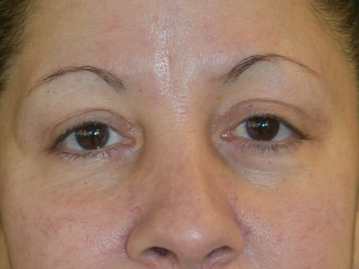 Upper  Blepharoplasty After