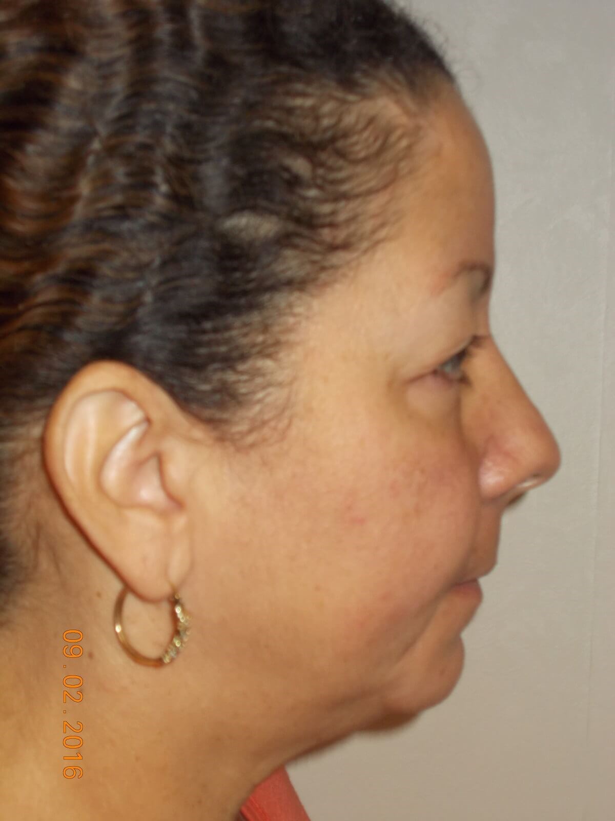 Upper Blepharoplasty Before