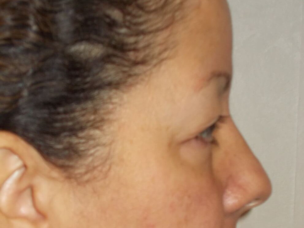 Upper Blepharoplasty Before