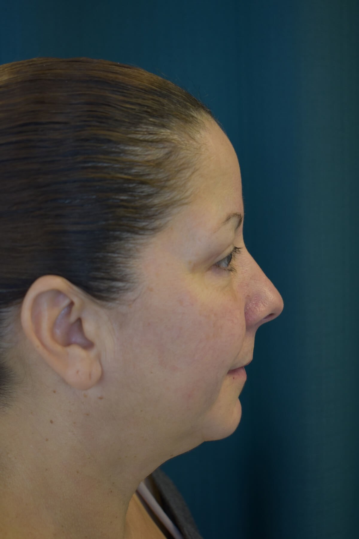 Upper Blepharoplasty After