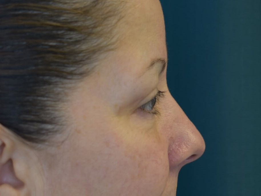 Upper Blepharoplasty After