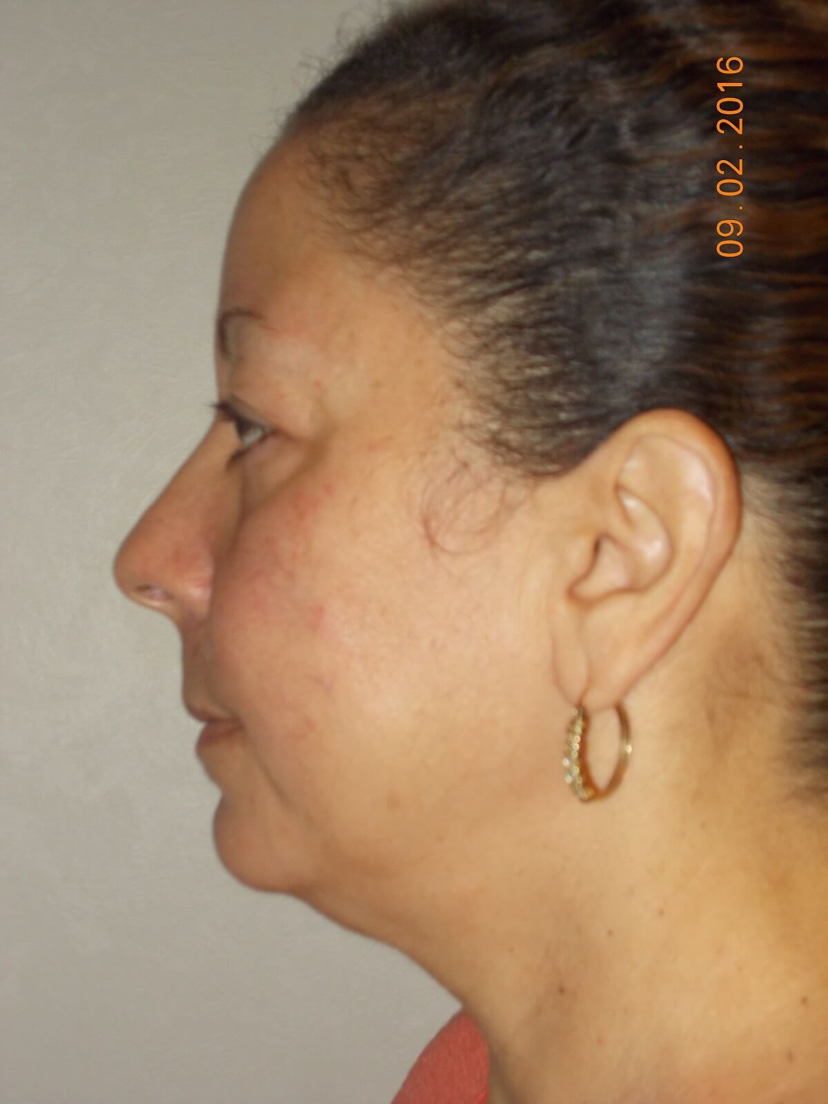 Upper Blepharoplasty Before