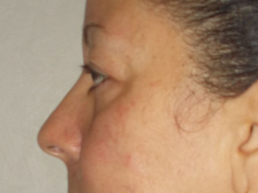Upper Blepharoplasty Before
