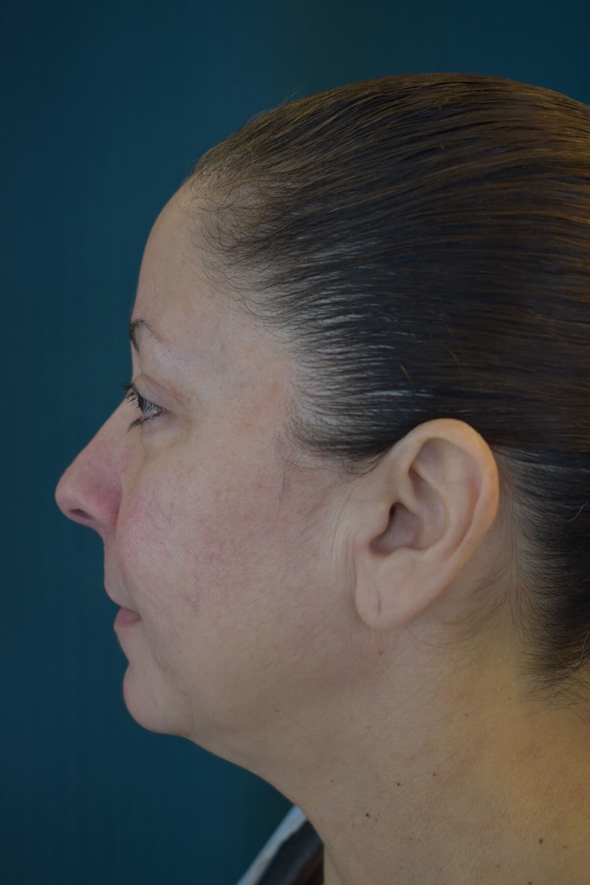 Upper Blepharoplasty After