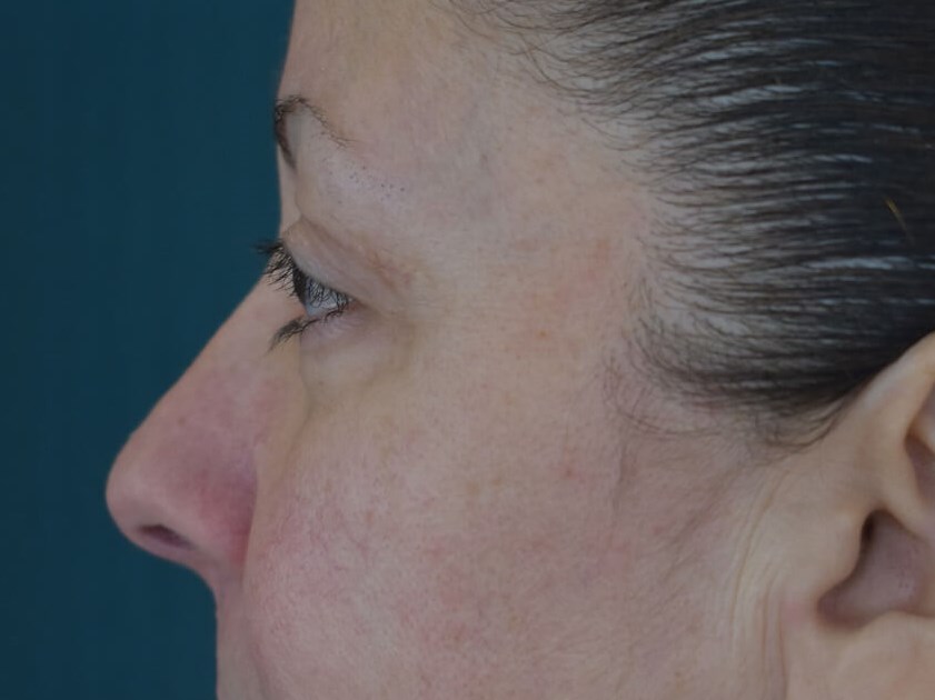 Upper Blepharoplasty After