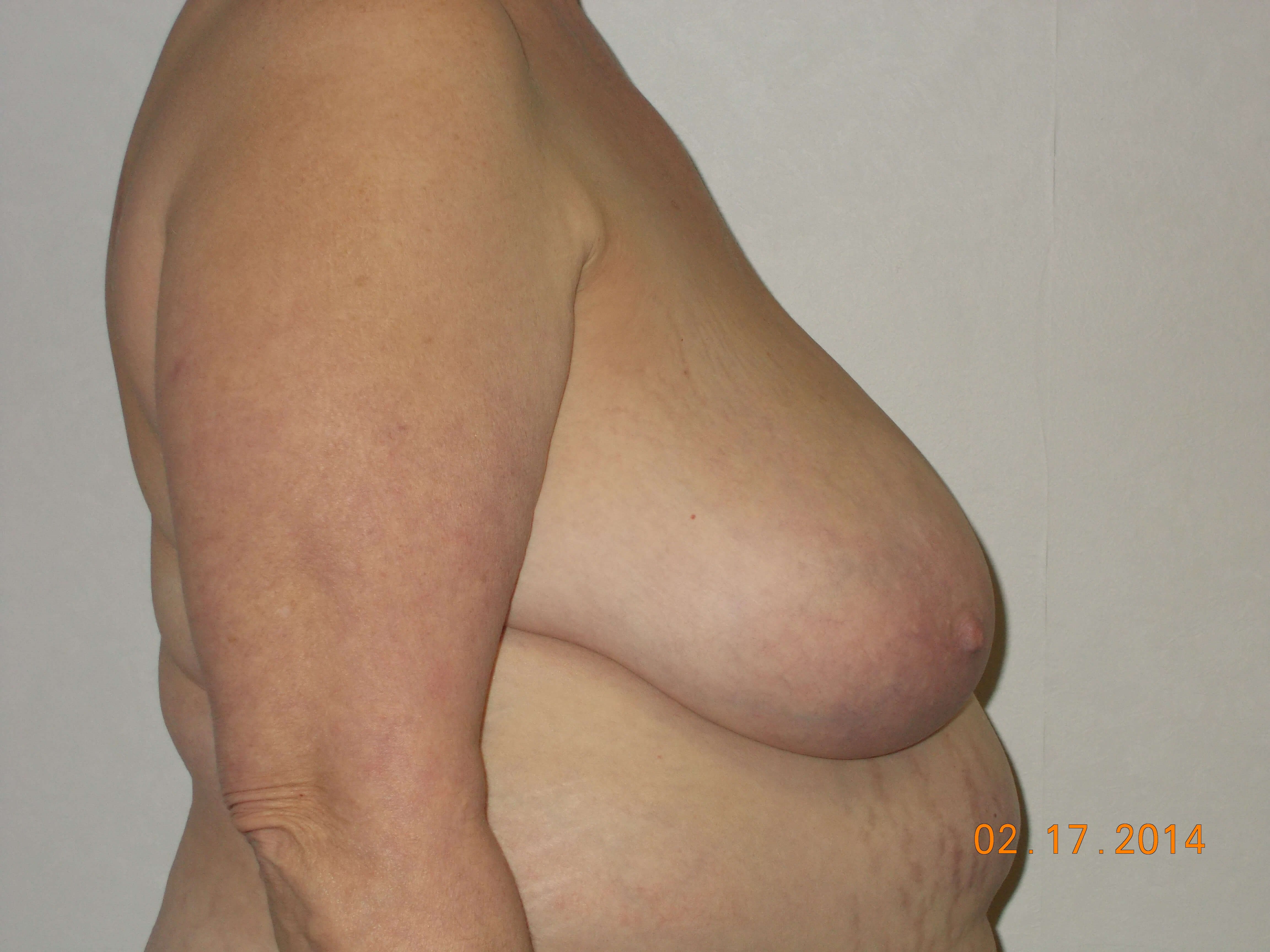 Side View Before