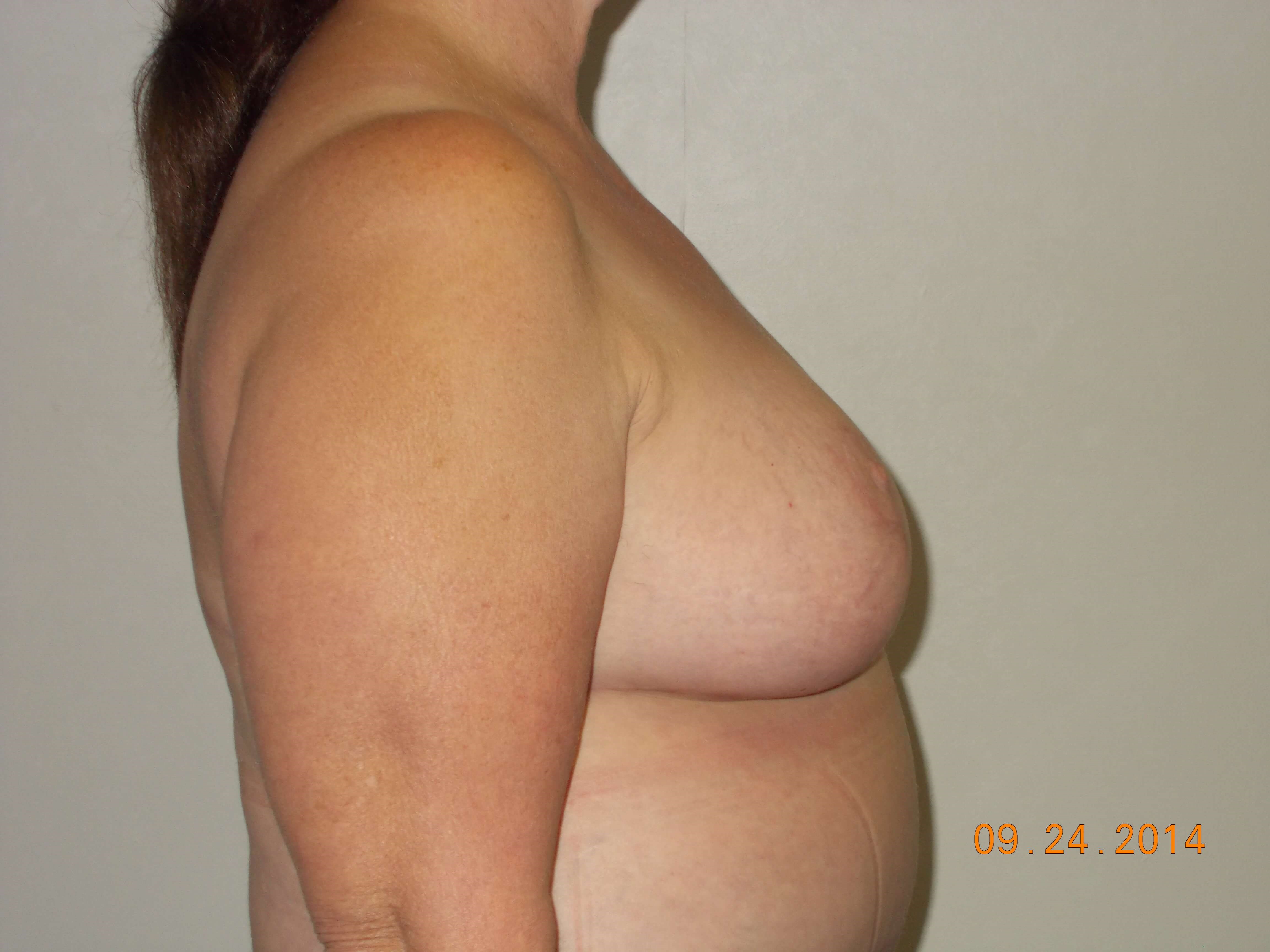 Side View After