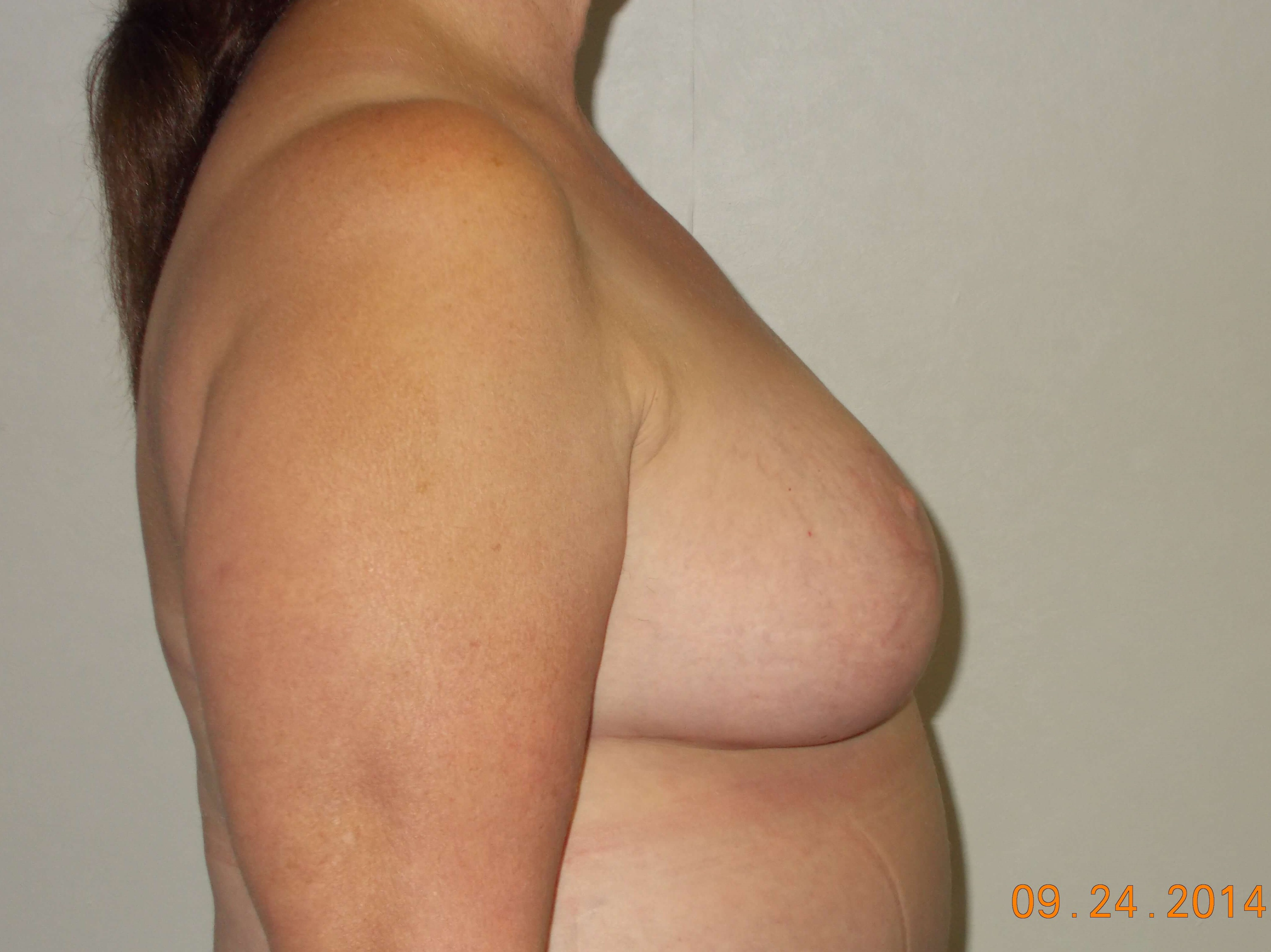 Side View After