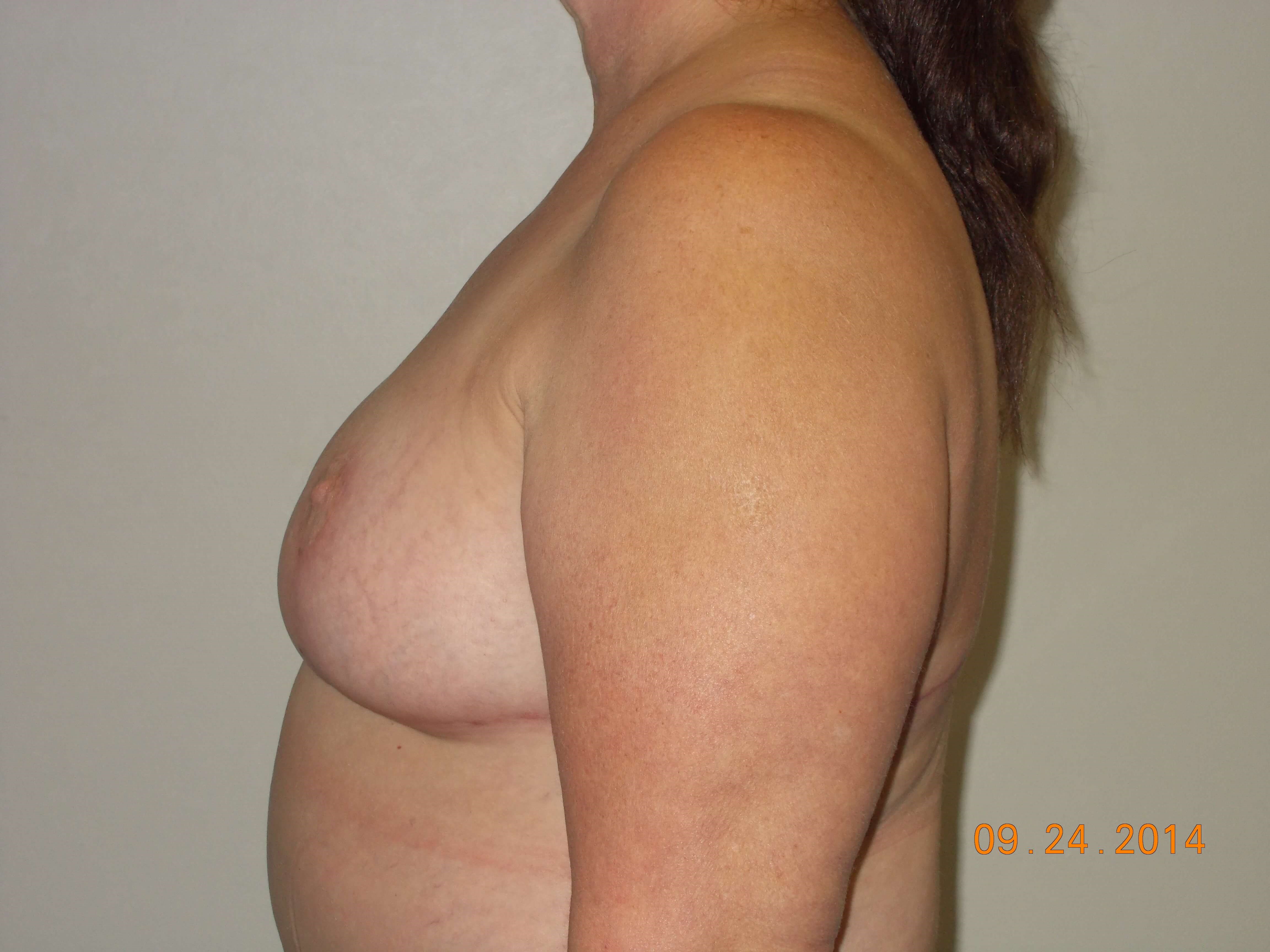Side View After