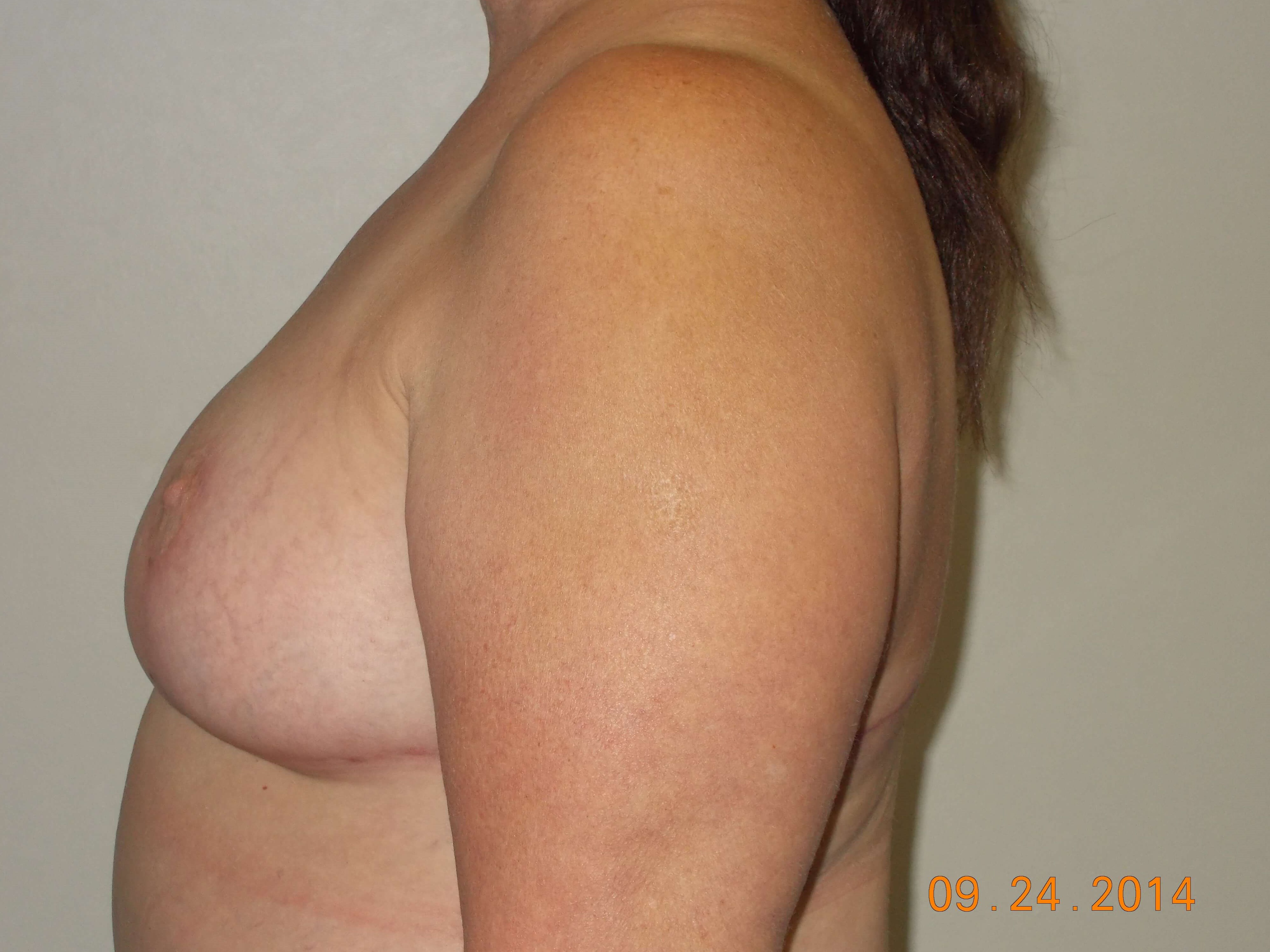 Side View After