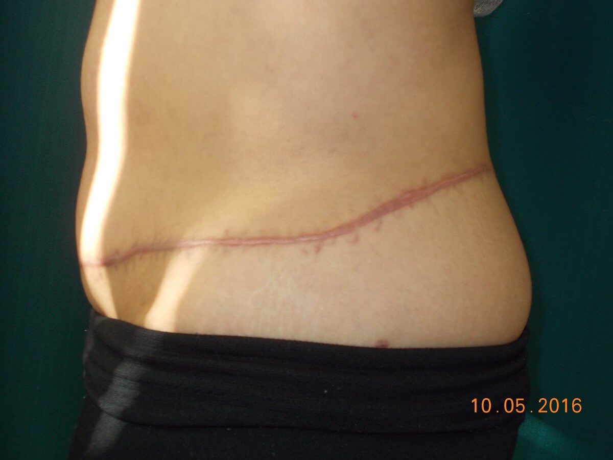 Alternate Side View Before