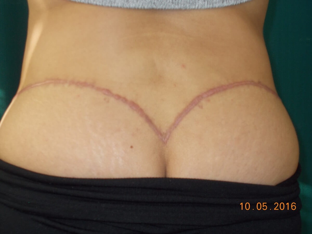 Back View Before