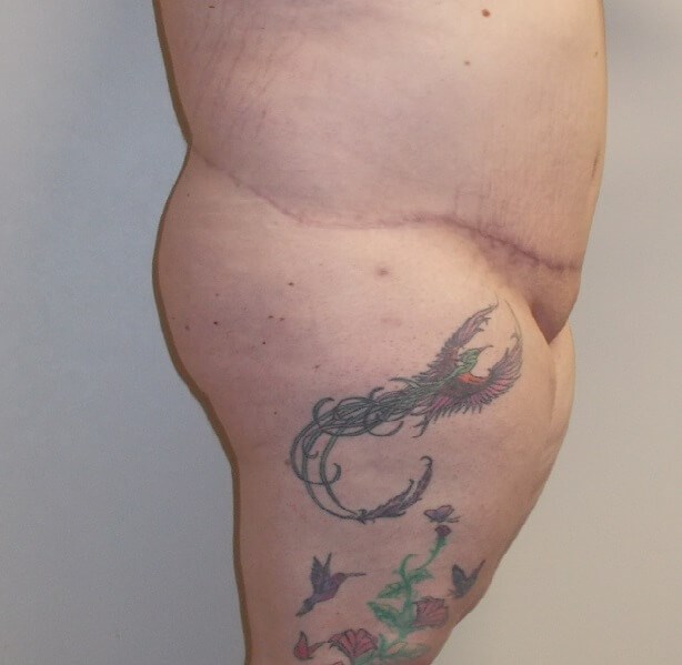 Side View Before