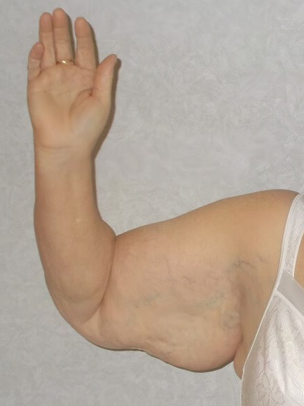 Front View Right Arm Before