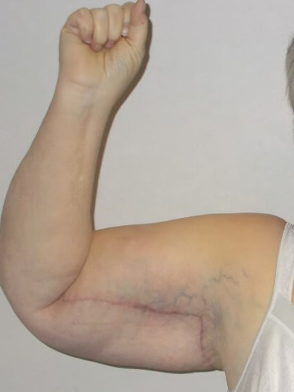 Front View Right Arm After