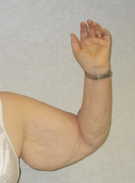 Front View Left Arm Before