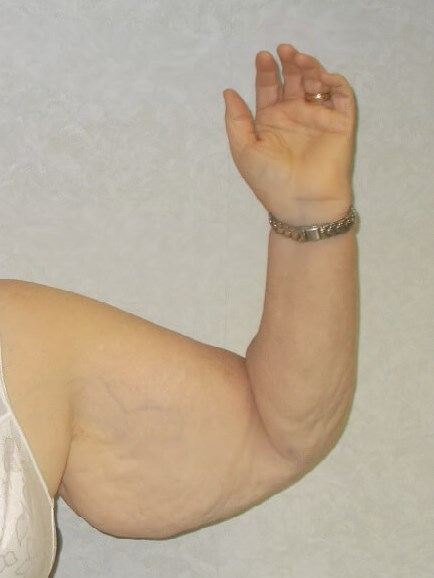 Front View Left Arm Before