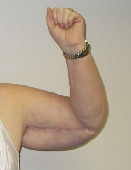 Front View Left Arm After
