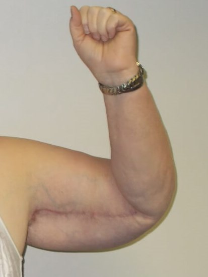 Front View Left Arm After