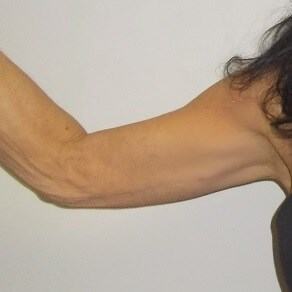 Front View Right Arm Before