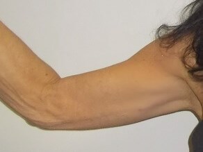 Front View Right Arm Before