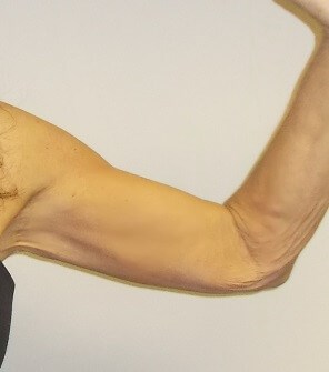 Front View Right Arm After