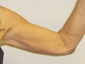 Front View Right Arm After