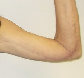 Front View Left Arm After