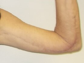 Front View Left Arm After