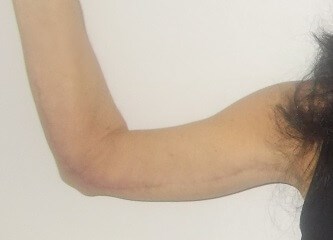 Front View Left Arm Before
