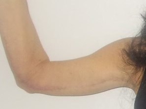 Front View Left Arm Before