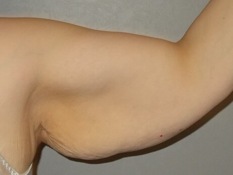 Front View Left Arm Before