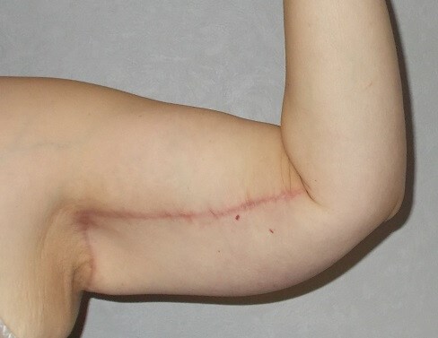 Front View Left Arm After