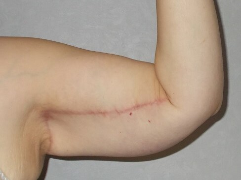 Front View Left Arm After