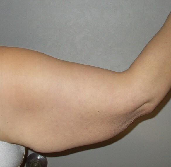 Back View Right Arm Before