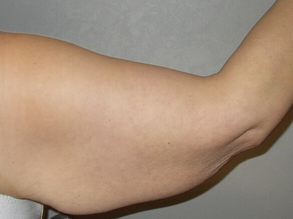 Back View Right Arm Before