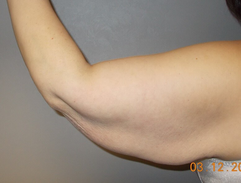 Back View Left Arm Before