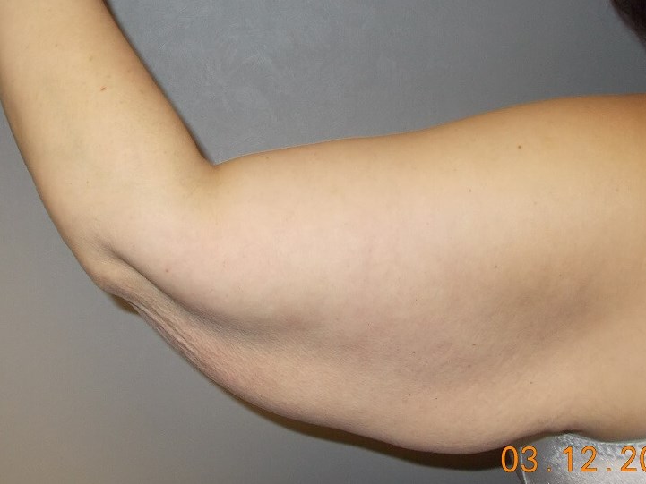 Back View Left Arm Before
