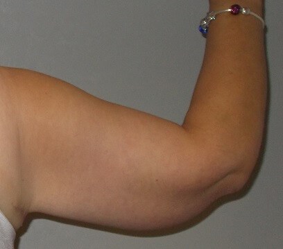 Back View Right Arm After