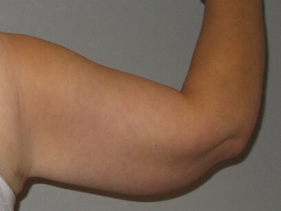 Back View Right Arm After