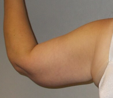 Back View Left Arm After